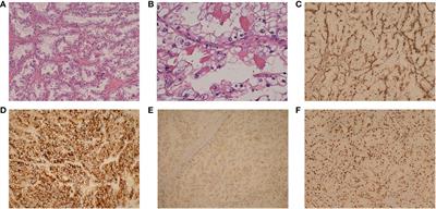 Case report: Excessive daytime sleepiness as a presenting manifestation of autoimmune glial fibrillary acidic protein astrocytopathy